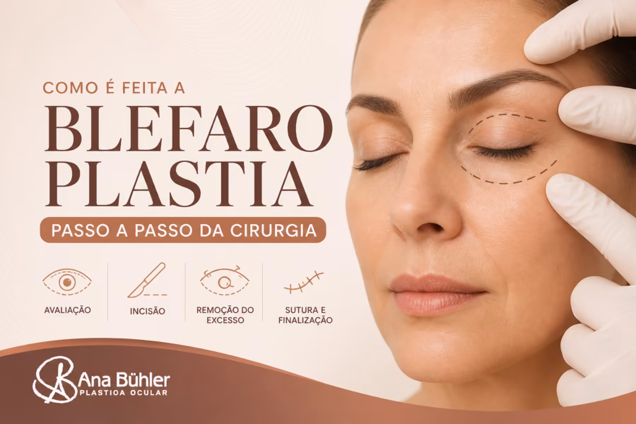 Sequência de etapas da cirurgia de blefaroplastia: marcação das pálpebras, anestesia, incisão, tratamento de tecido e sutura