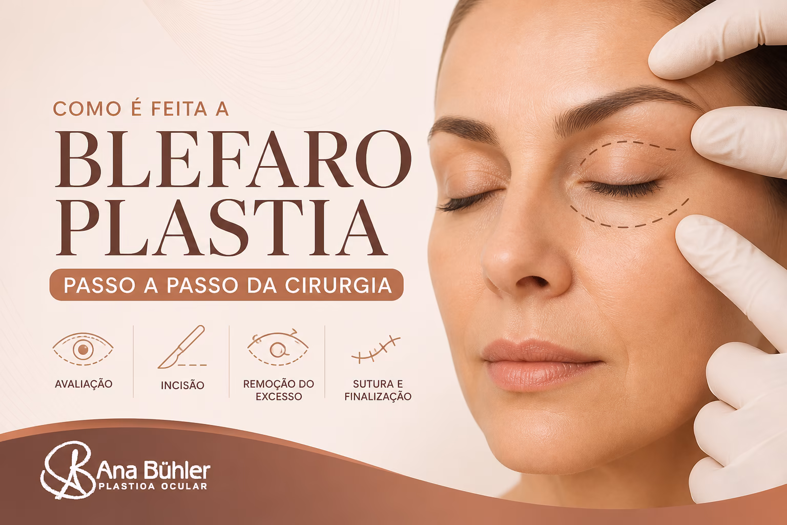 Sequência de etapas da cirurgia de blefaroplastia: marcação das pálpebras, anestesia, incisão, tratamento de tecido e sutura