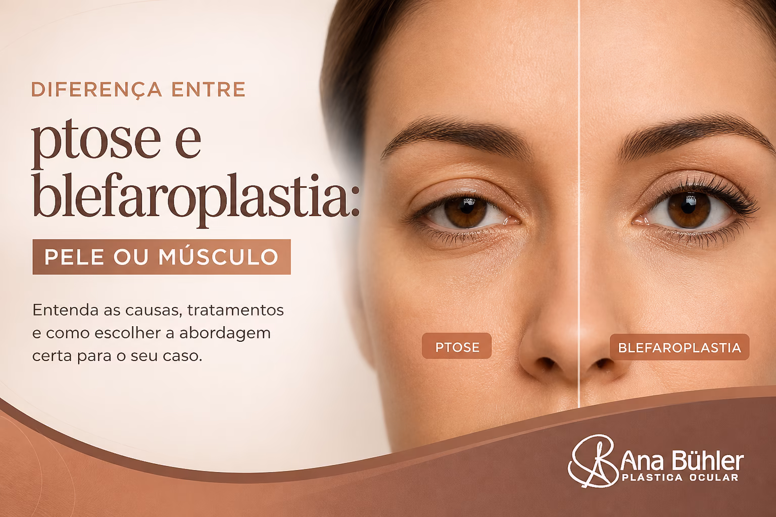 Comparação visual entre dermatocálase (excesso de pele na pálpebra) e ptose palpebral (pálpebra baixa por fraqueza do músculo levantador)